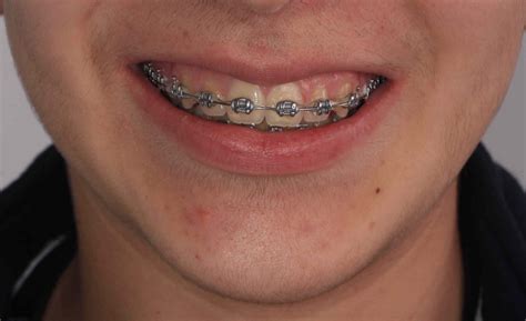 costo de brackets metalicos|ortodoncia brackets precio.